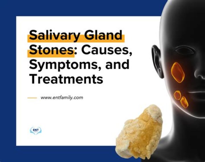 What causes salivary stone