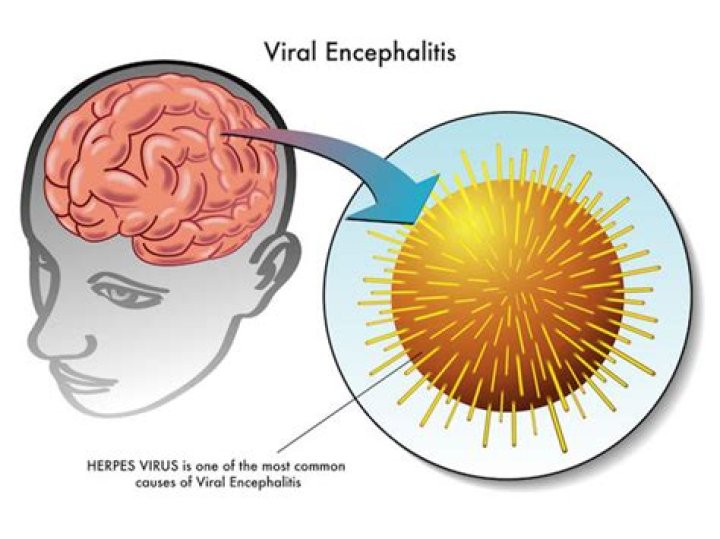 What causes viral encephalitis