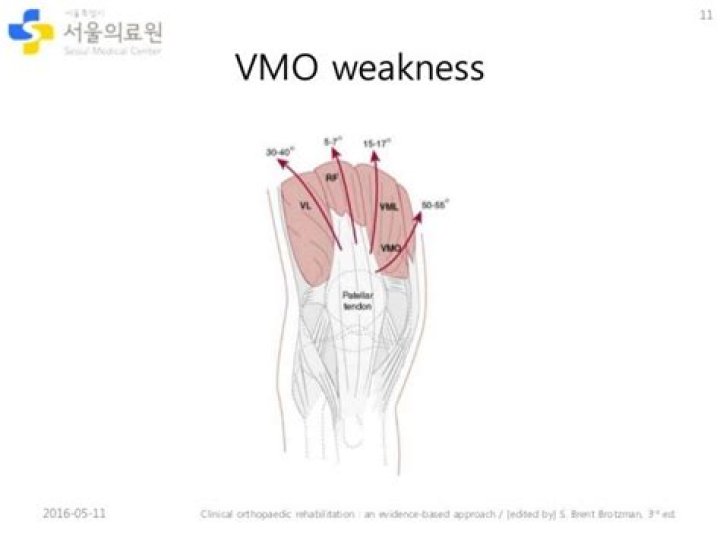 What causes VMO weakness