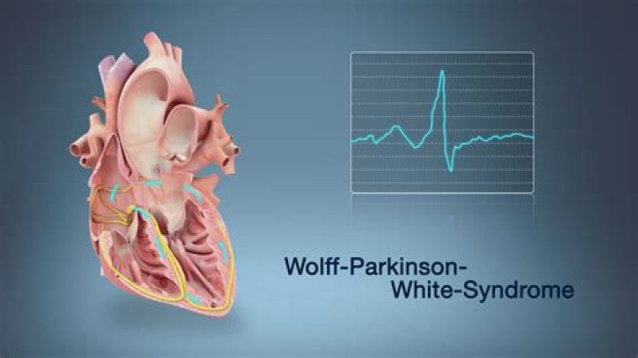 What causes Wolff Parkinson White Syndrome