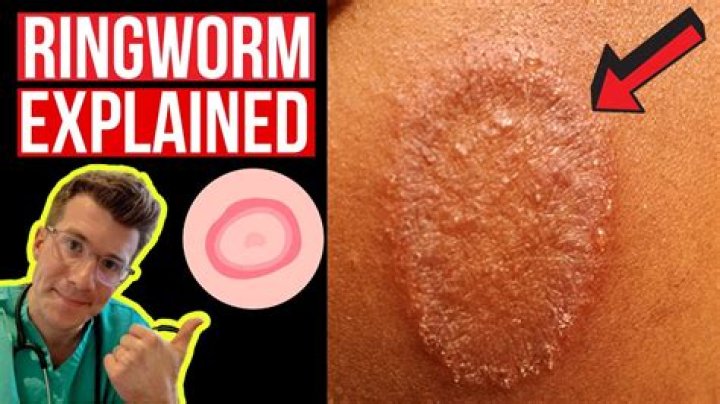 What causes worms to come out of skin