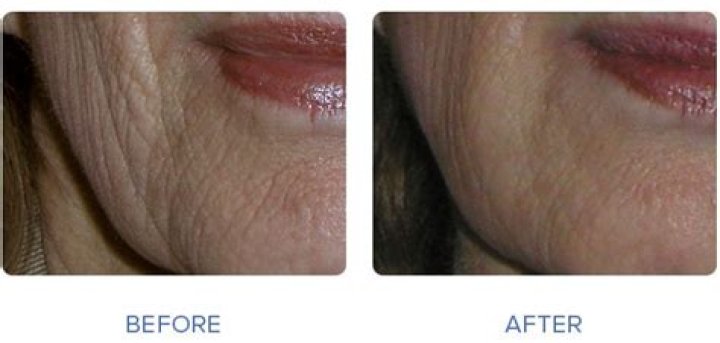 What do dermatologists recommend for Crepey skin
