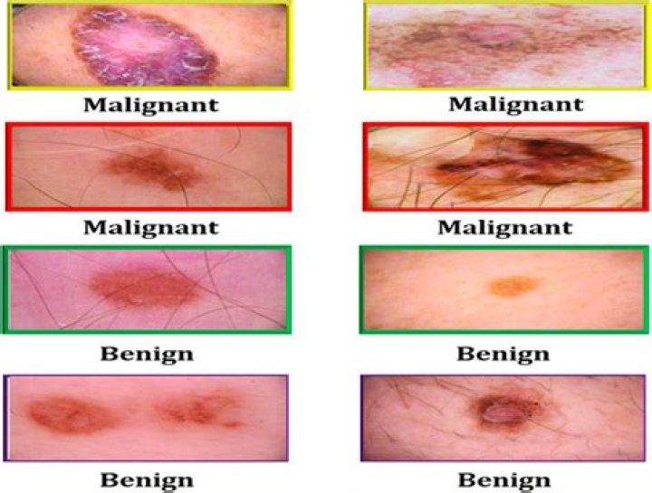 What does a cancerous skin lesion look like