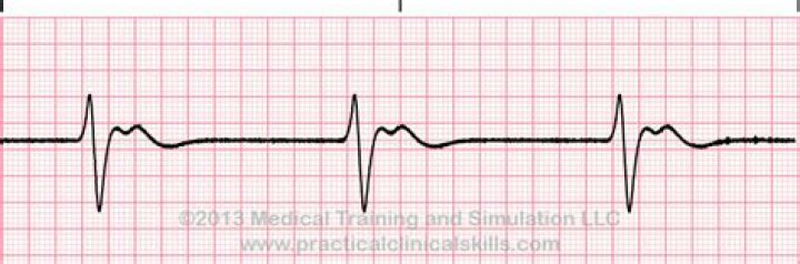 What does a Idioventricular rhythm look like