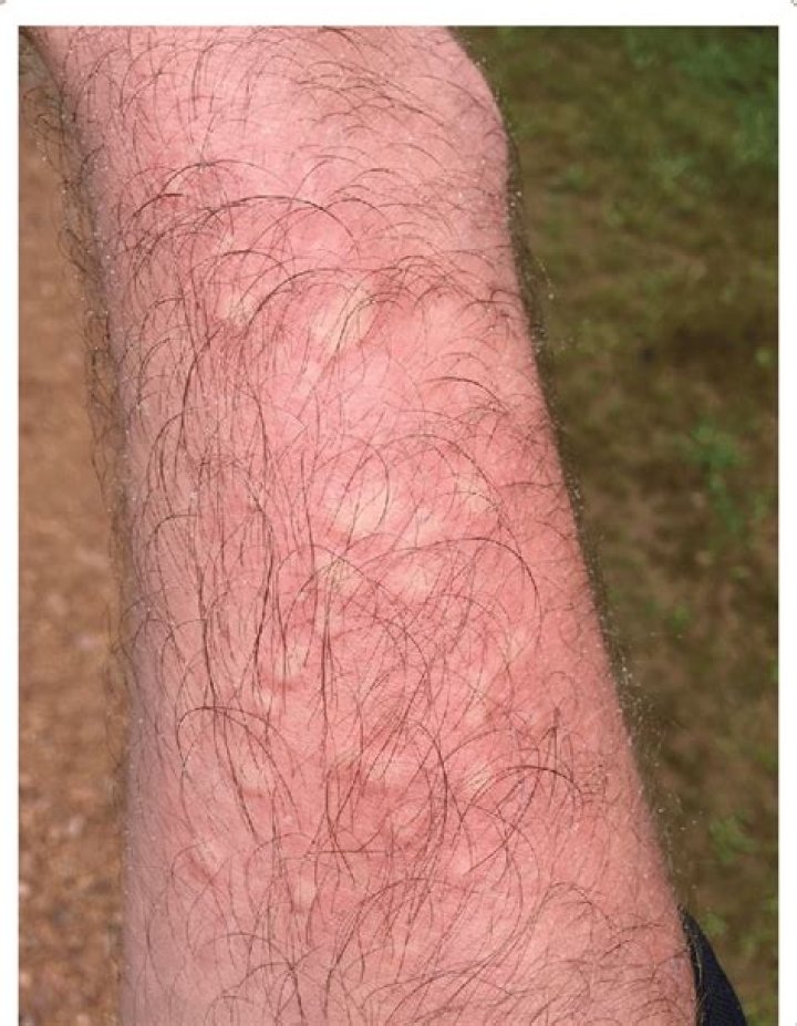 What does bull nettle rash look like