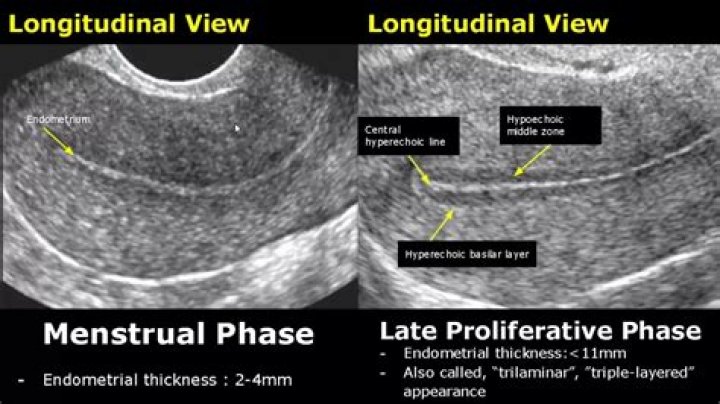 What does Endo mean on an ultrasound