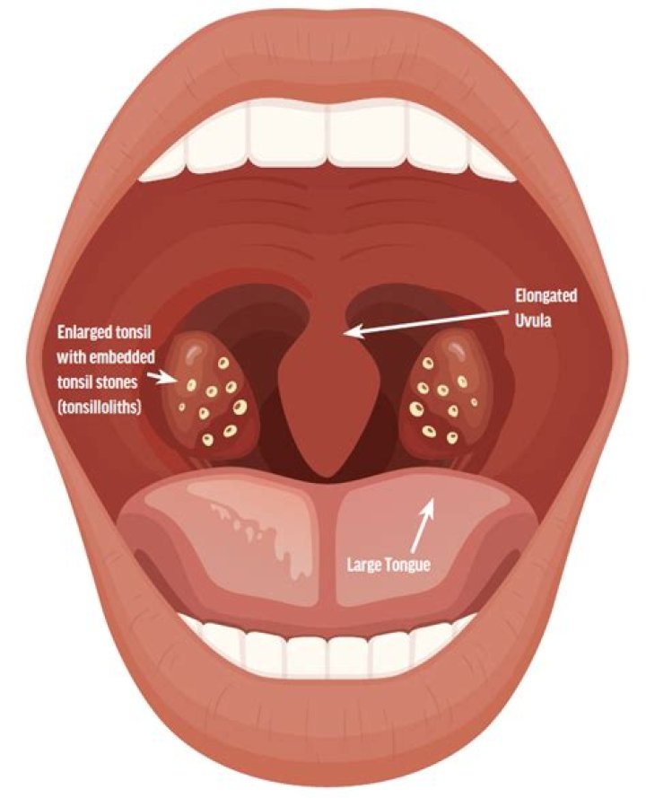 What does it mean if your uvula is touching your tonsils