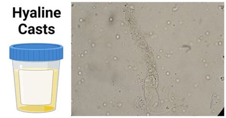 What does it mean to have casts in urine