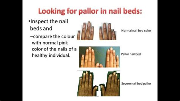What does pallor mean in medical terms
