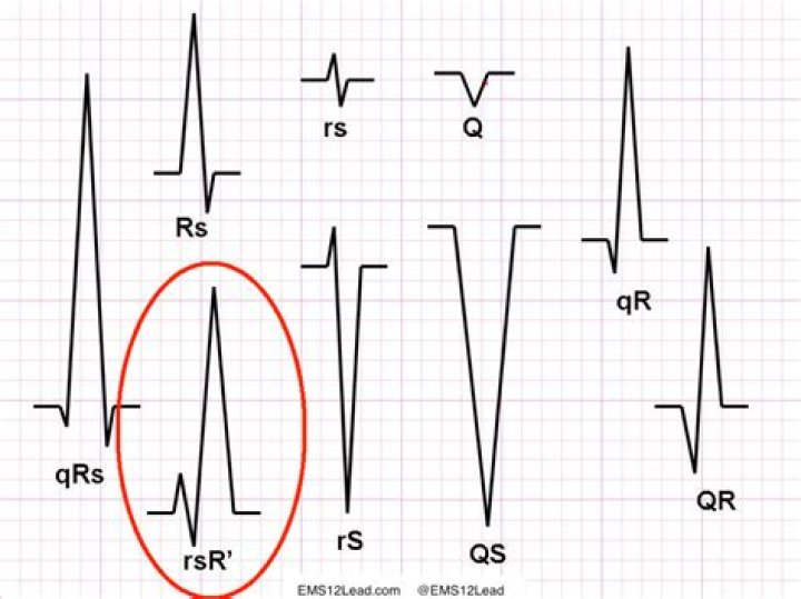 What does RSR on ECG mean