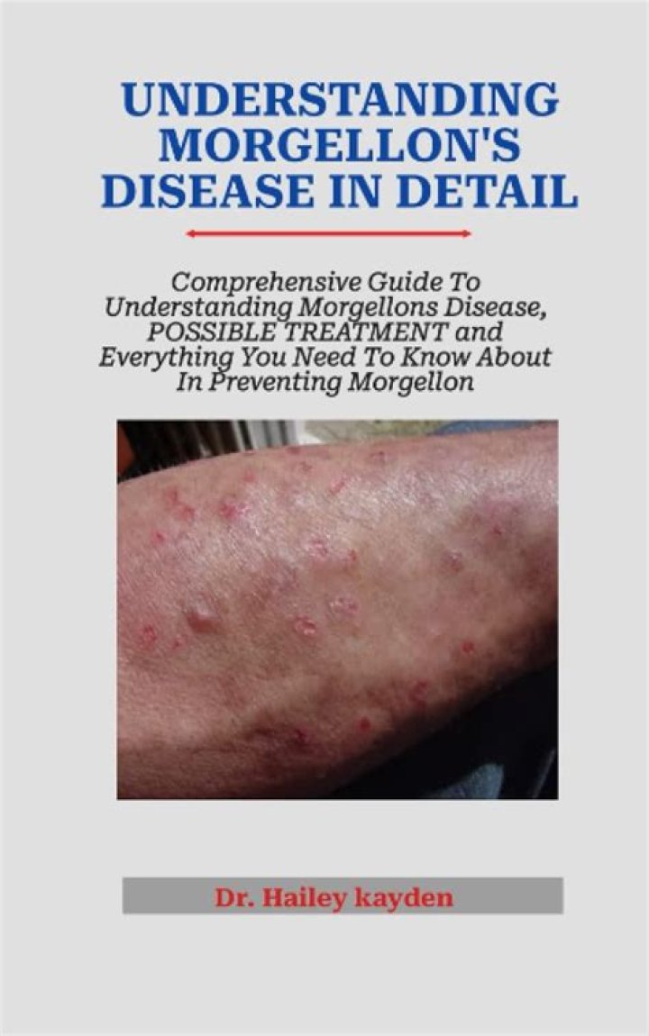 What does the CDC say about Morgellons disease