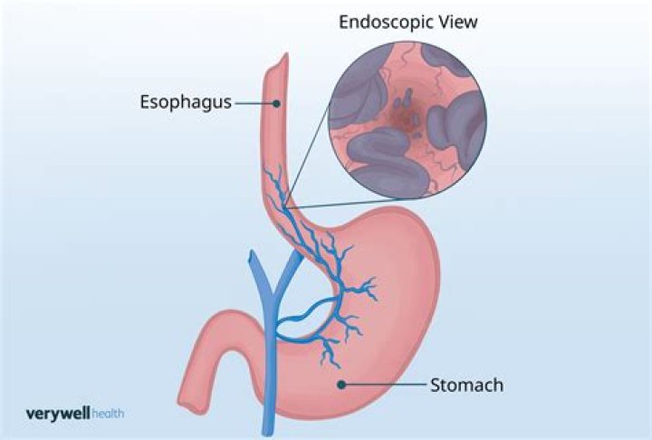 What happens if esophageal varices rupture