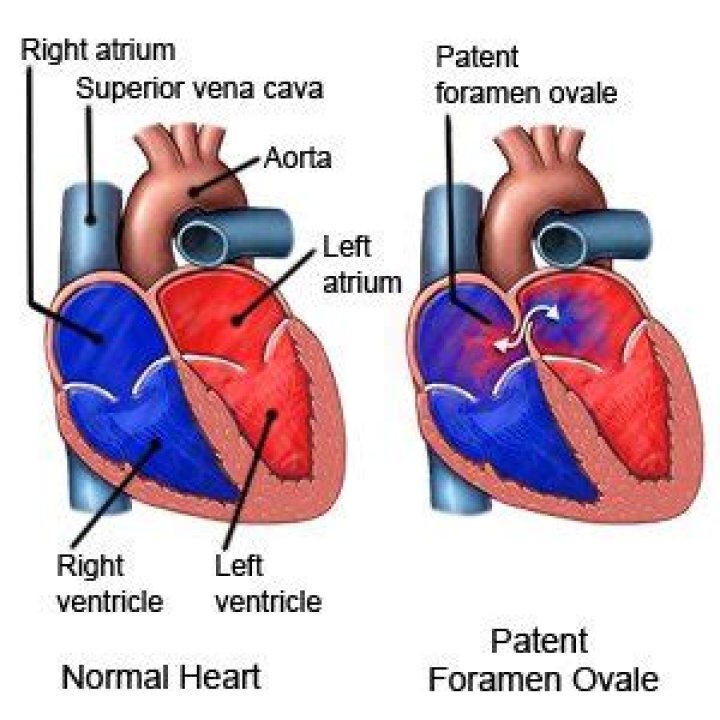 What happens if the foramen ovale fails to close