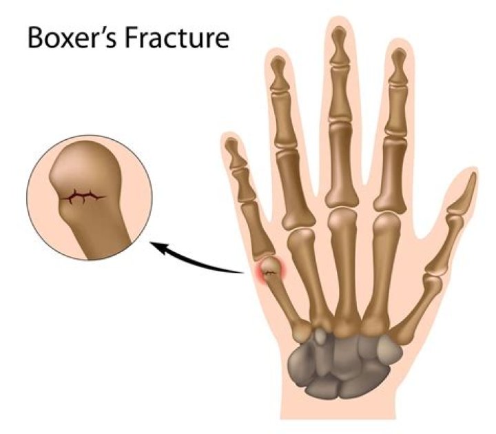 What is a boxers fracture of the hand