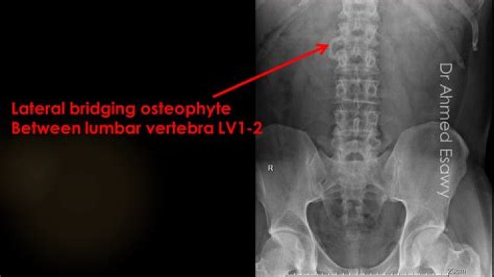 What is a bridging Osteophyte