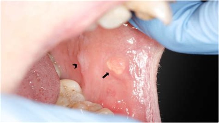 What is a buccal lesion