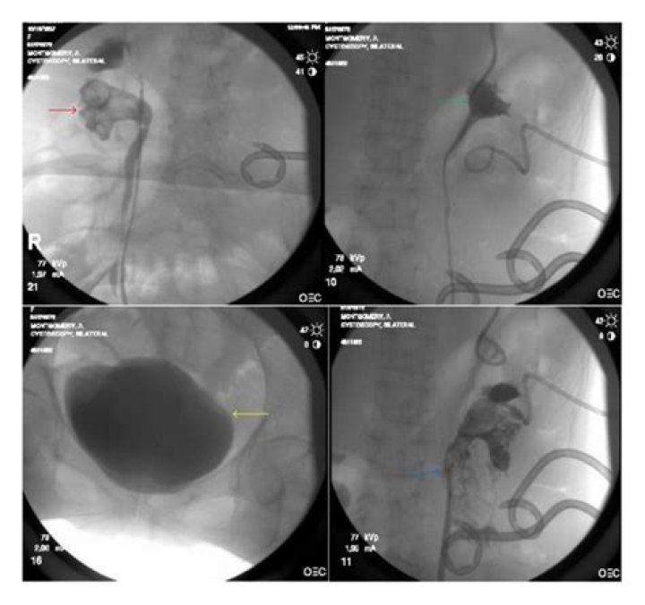 What is a cystoscopy bilateral retrograde