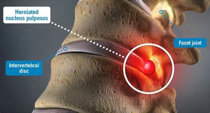 What is a herniated nucleus pulposus in lay terms