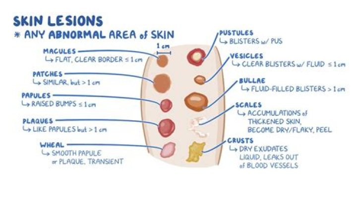 What is a Macule on the skin