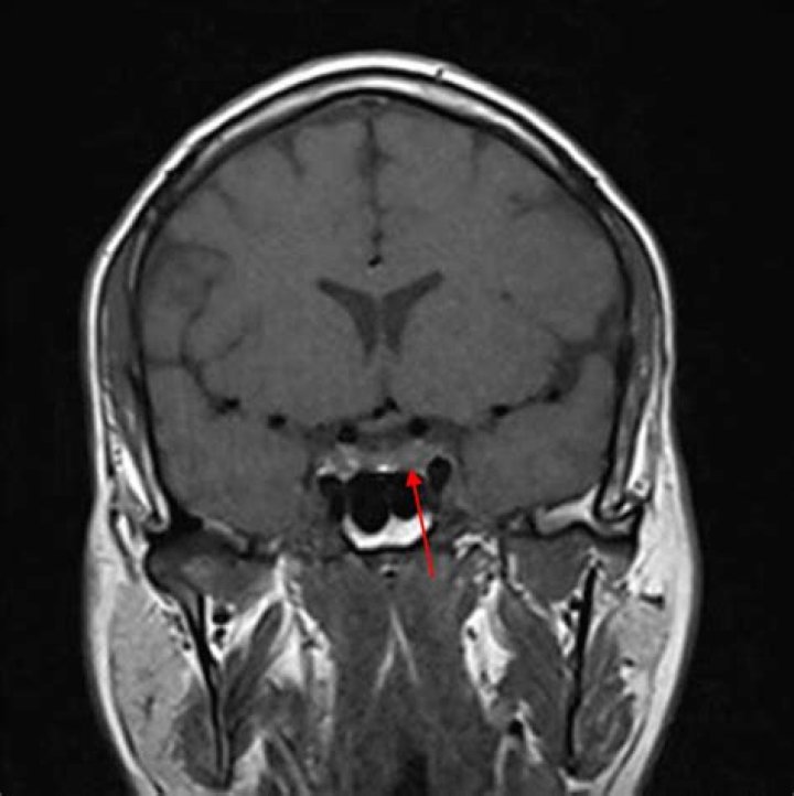 What is a Microadenoma