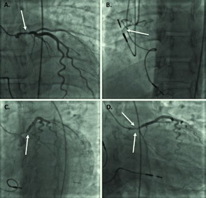 What is a selective coronary angiography