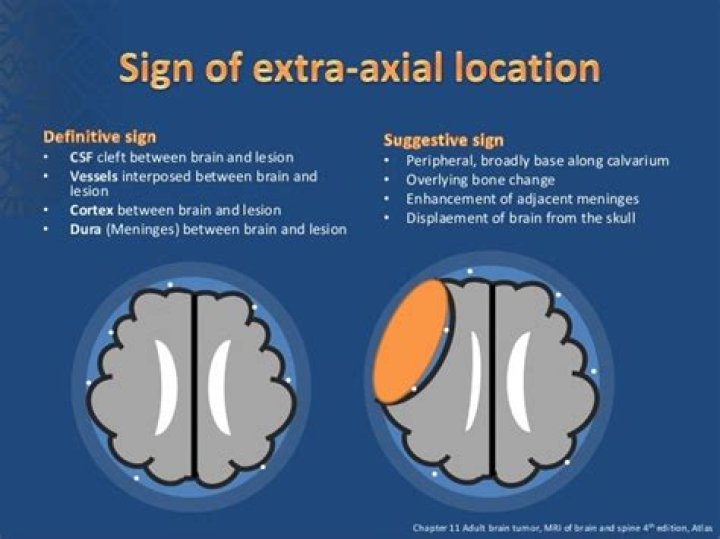 What is an extra axial lesion