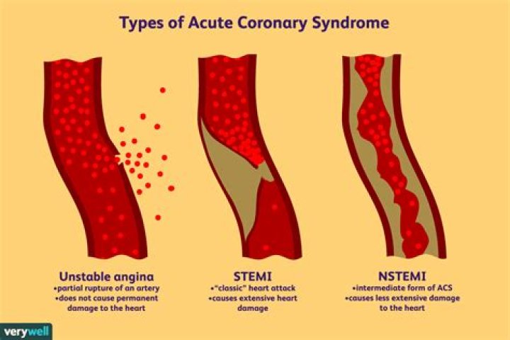What is an Nstemi