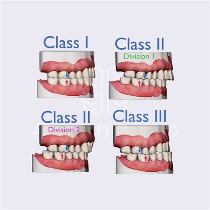What is Angle classification