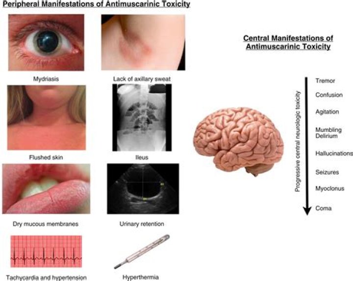 What is anticholinergic toxicity