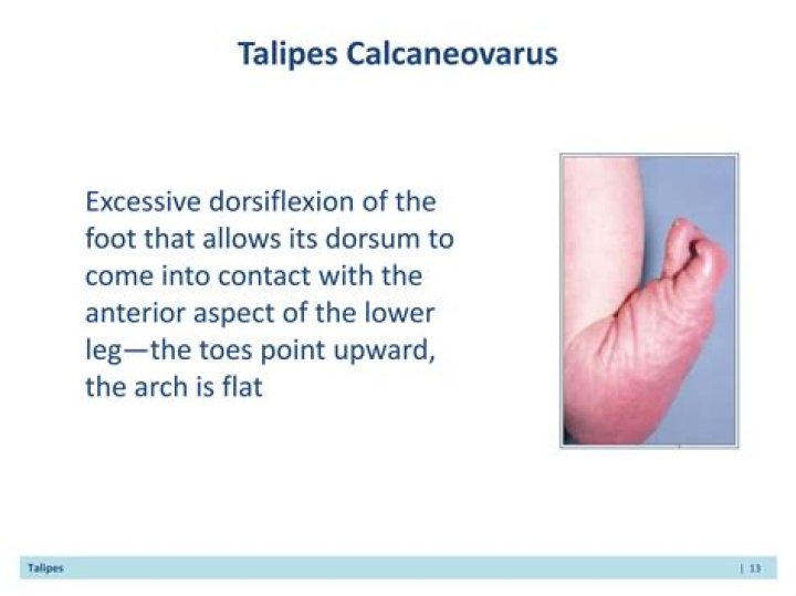 What is congenital Talipes Calcaneovarus