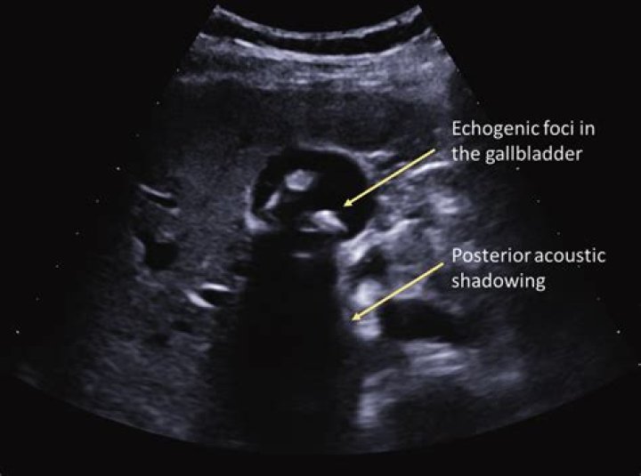 What is echogenic focus in gallbladder