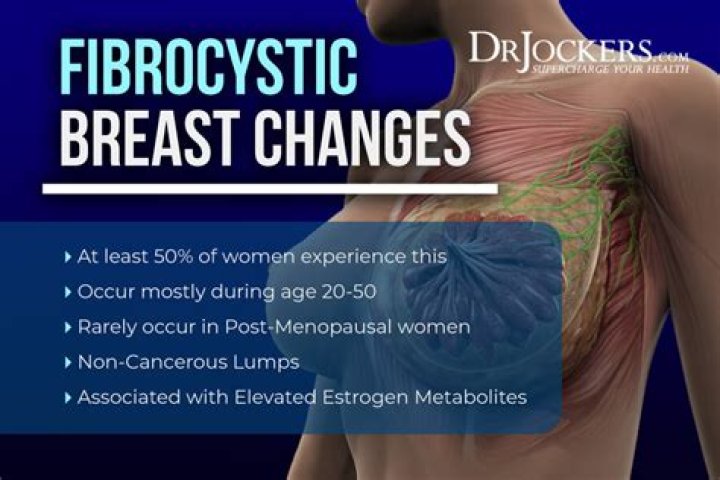 What is fibrocystic breast condition caused by