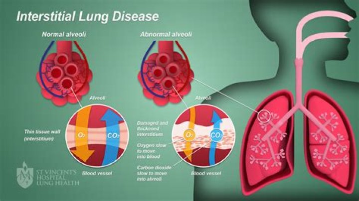 What is lung tissue disease