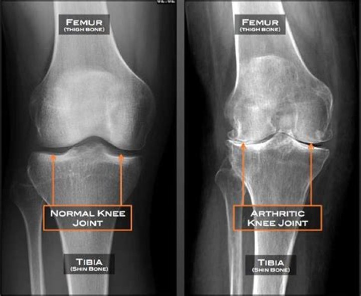 What is nodal osteoarthritis