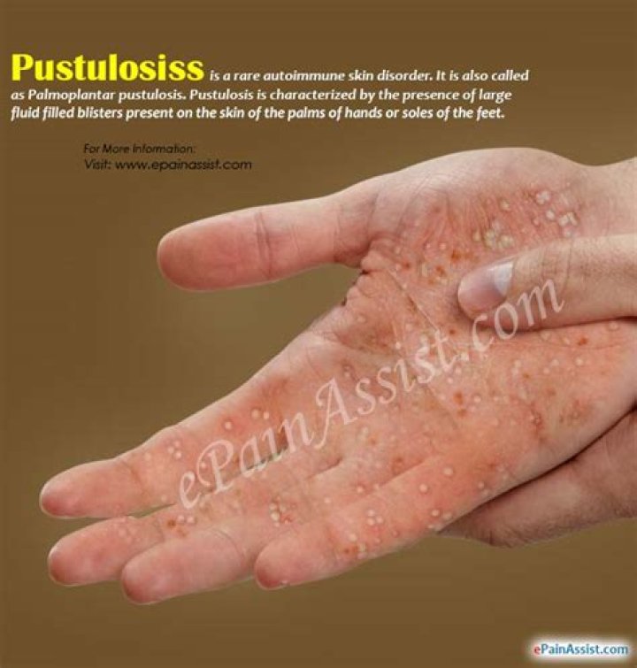 What is Pustulosis