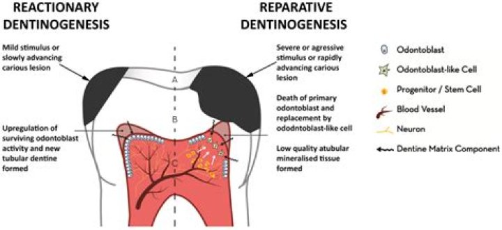 What is reactionary dentin