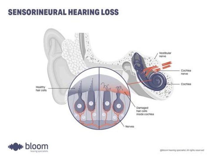 What is sensorineural hearing loss caused by