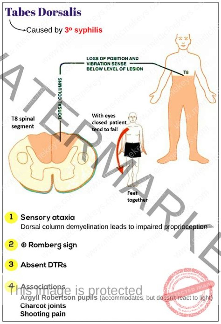 What is tabes dorsalis diagnosis