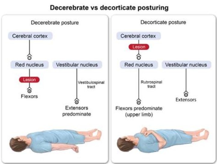 What is the difference between Decerebrate and Decorticate posturing