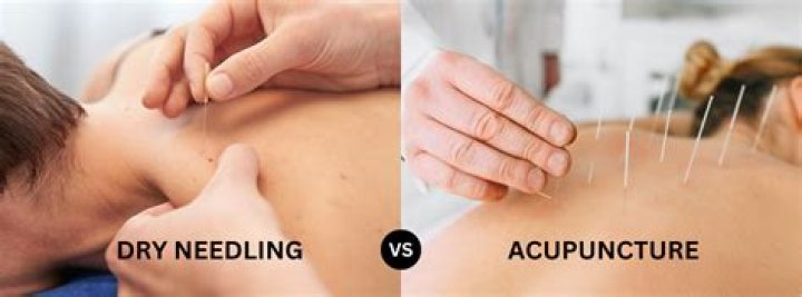 What is the difference between dry needling and acupuncture
