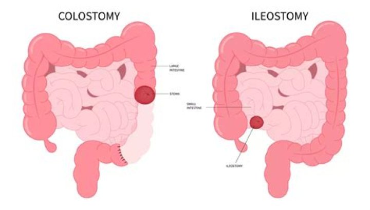 What is the difference between ileostomy and colostomy