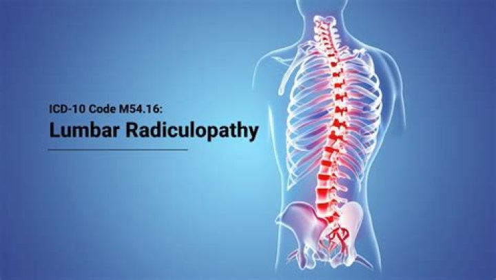 What is the ICD 10 code for lumbar radiculopathy