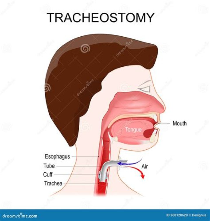 What is the main purpose of the tracheostomy cuff