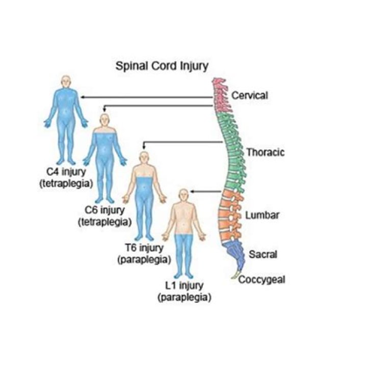 What is the most common spinal cord injury