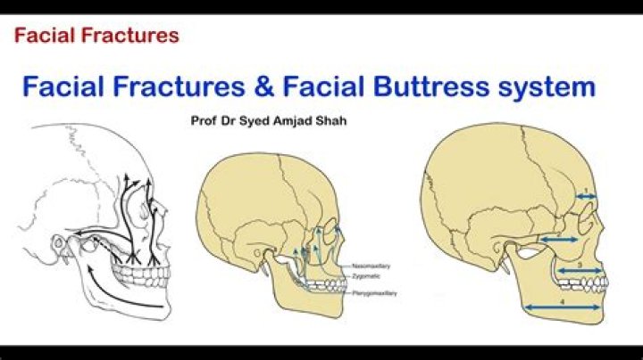 What is the zygomatic buttress