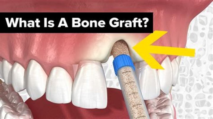 What is Trinity bone graft