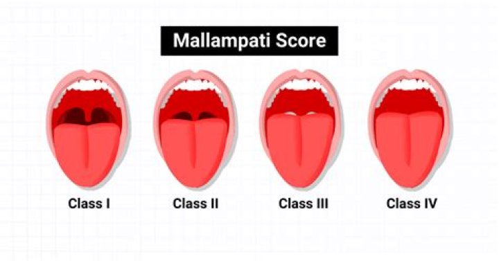 What is visualized with a Class 3 Mallampati score