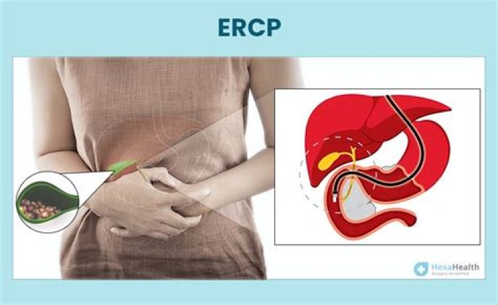 What should I do after ERCP