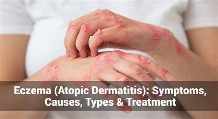 What triggers dermatitis