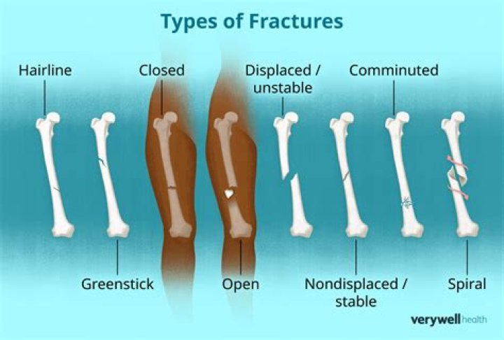 What type of fracture involves a bone breaking and splintering into pieces